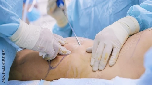 Close-up of surgeons using a cannula to perform liposuction on a marked abdomen in a sterile surgical environment.