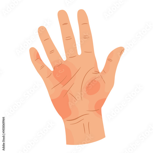 Bee Sting Resulting in Swollen Hand with Redness  