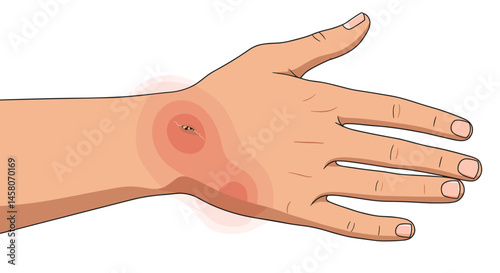 Bee sting on swollen hand illustration with redness  