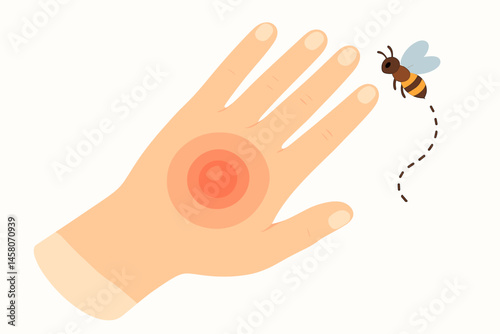 Bee sting causing redness on a hand with illustration style  
