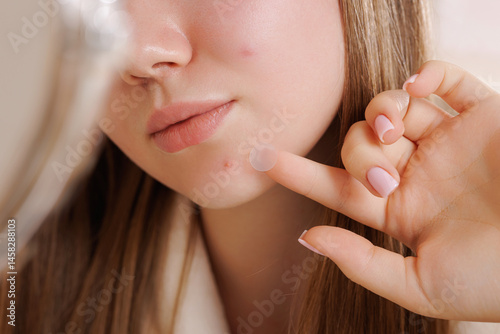 Obraz na plátne Girl placing hydrocolloid patch on acne spot for pimple treatment and skincare