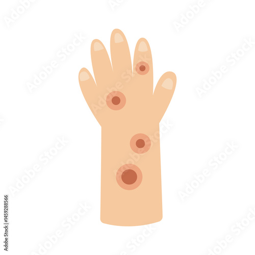 anthrax infection disease concept