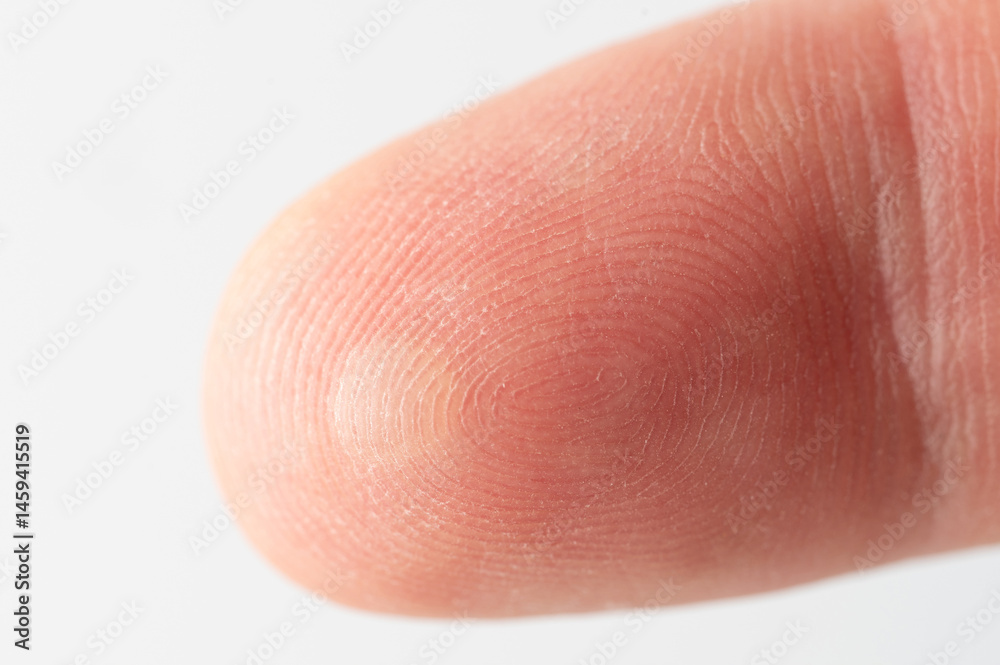 Hurted finger skin with blister