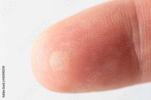 Obraz na płótnie Hurted finger skin with blister w salonie