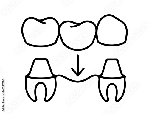Dental Bridge Installation with Arrow Indicating Placement on Abutment Teeth, Prosthodontics, Tooth Replacement, Restorative Dentistry, Oral Health Treatment