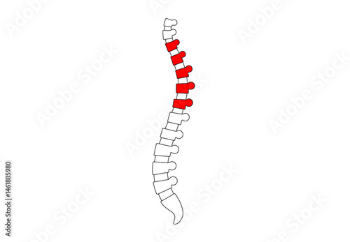 Scoliosis medical poster