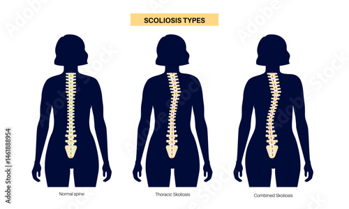Scoliosis medical poster