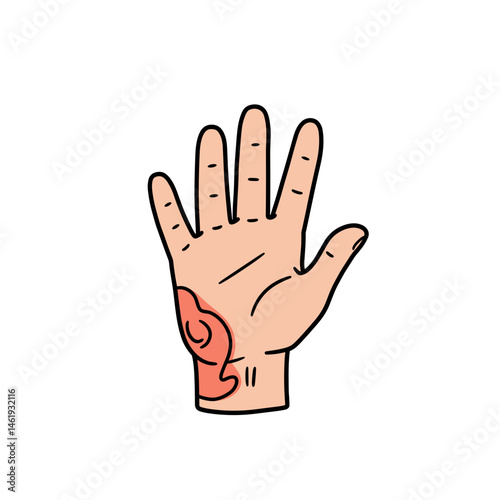 Burned hand with a blister, showing redness and injury, on a white background