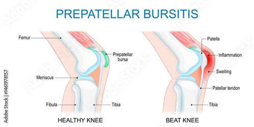 Prepatellar bursitis. Knee joint inflammation