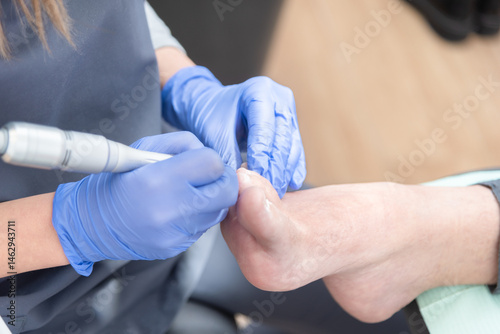 Podiatrist performing ingrown toenail treatment with electric device