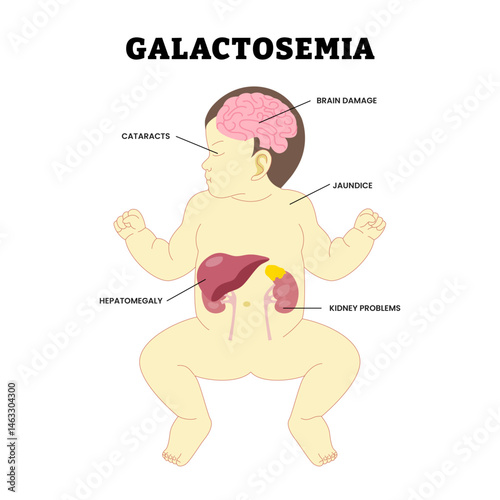 Baby Galactosemia genetic disorder  yellow skin and eyes or jaundice disorder, educational medical poster design healthcare, labeled cataracts, brain damage, hepatomegaly, kidney disease illustration.