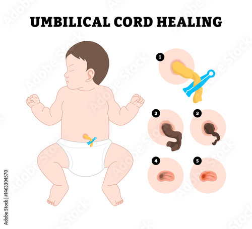 Baby Umbilical Cord Care Healing procedure steps, educational medical poster design healthcare, labeled after birth weeks cleaning umbilicus dry pus swollen fall off scar tissue.