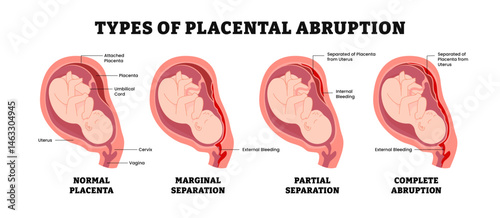 Different types of placental abruption types, educational medical poster design healthcare, labeled normal placenta, marginal and partial separation, complete abruption. Pregnancy complication.