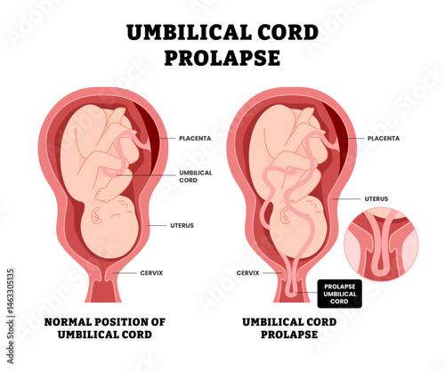 Baby umbilical cord prolapse, educational medical poster design healthcare, labeled umbilical cord slips out of the uterus, descends through the cervix, umbilical cord exits the cervical os.