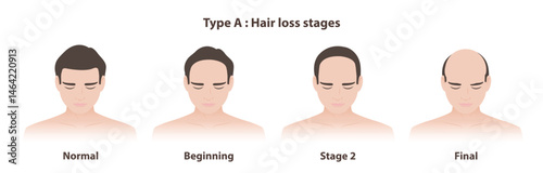 Type A hair loss stages in male pattern baldness vector illustration. Infographic stages of androgenetic alopecia, the hairline recedes from the front to the back. Hair care and problem concept.