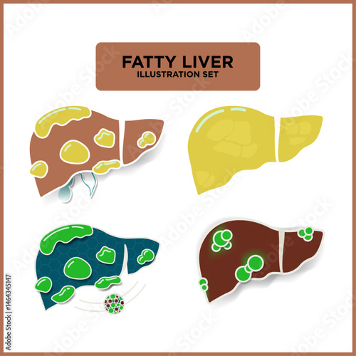 Unhealthy Fatty liver disease  illustration set. Damaged liver  with fat deposits in different colors. with and without shadows. Cartoon Liver damage.  Vector Illustration.