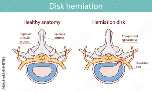 Herniated disc injury as labeled spinal pain explanation vector illustration