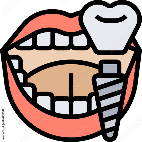 dental implant illustration on a white background    