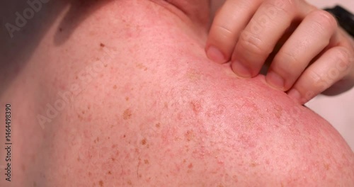 Woman hand gently touches sunburned skin on shoulder in room. Lady suffers form redness irritation and potential damage from excessive sun exposure