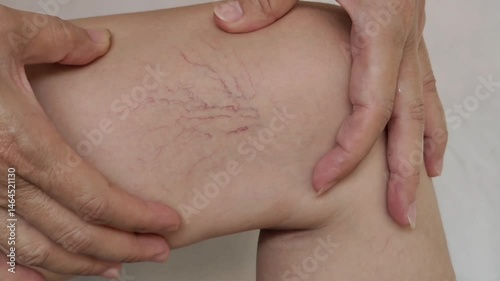 portrait the fingers holding the flabbiness and wrinkle, varicose veins and spider, problem circulation of blood, cramp and bulging on the leg of the woman, health care and beauty concept.