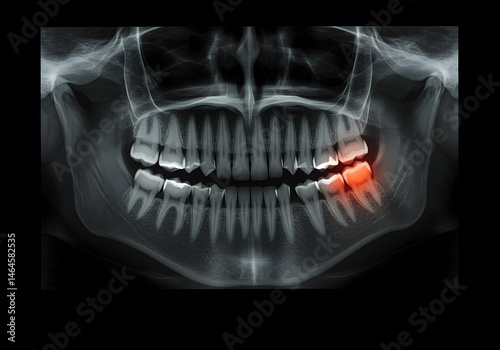 Panoramic Dental X-Ray Showing Impacted Wisdom Tooth and Inflammation