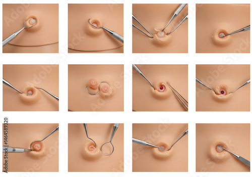 Umbilical Hernia Repair Simulation Training Kit: Step-by-Step Guide for Medical Professionals