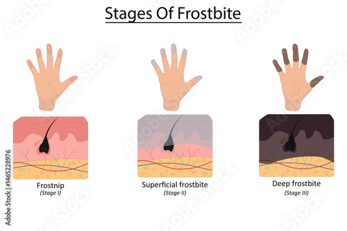 Stages of frostbite vector illustration