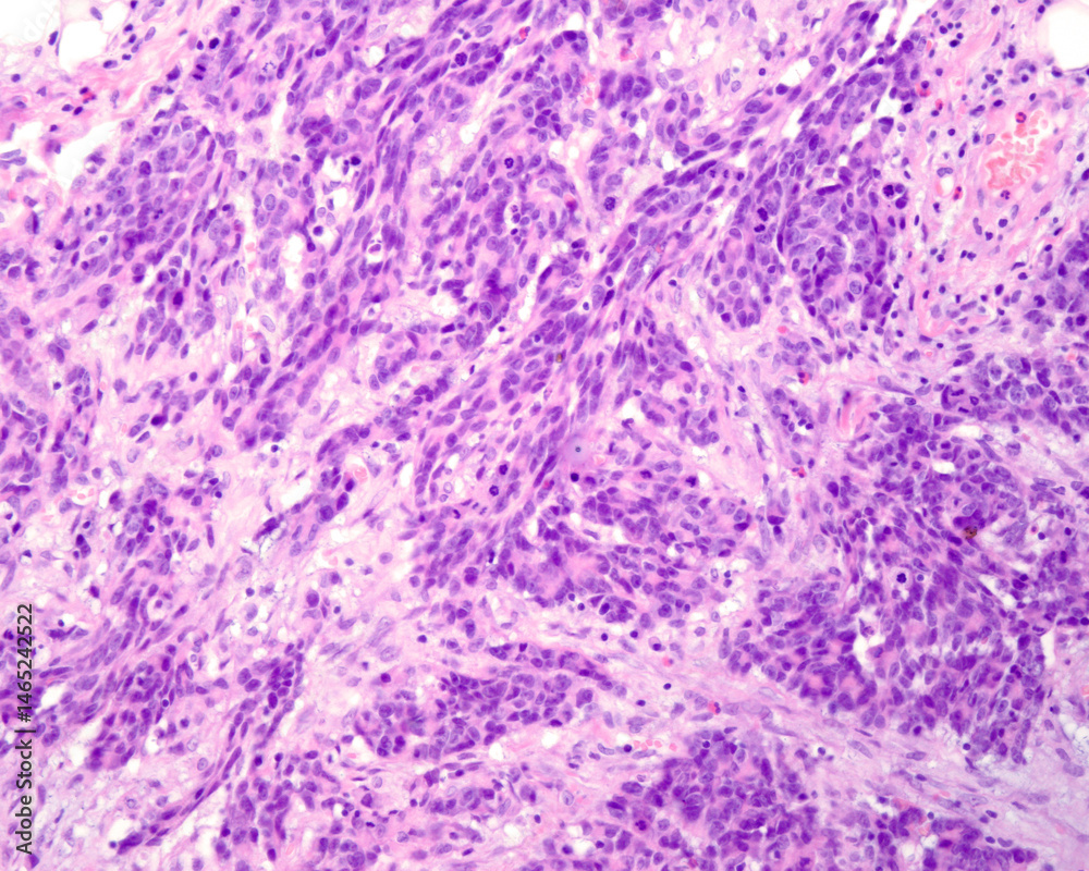 Obraz premium Undifferentiated adenocarcinoma. Metastatic nodule