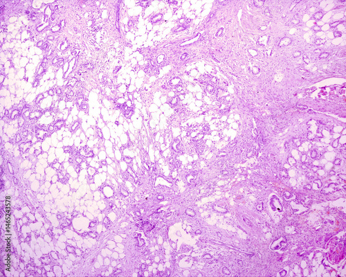 Adenocarcinoma. Metastatic nodule