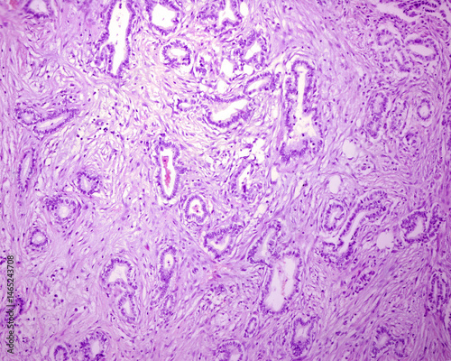 Adenocarcinoma. Metastatic nodule