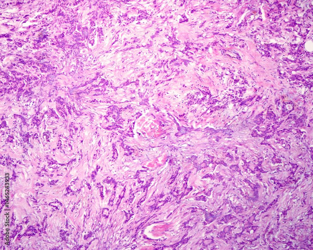 Undifferentiated adenocarcinoma. Metastatic nodule Undifferentiated adenocarcinoma. Metastatic nodule