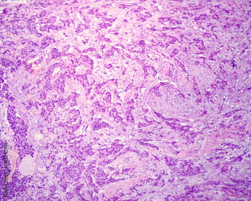 Undifferentiated adenocarcinoma. Metastatic nodule
