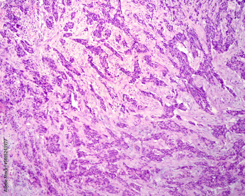 Undifferentiated adenocarcinoma. Metastatic nodule