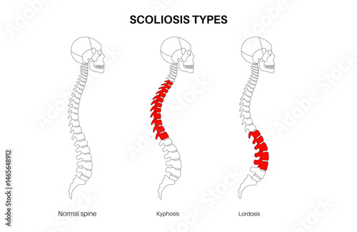 Scoliosis medical poster