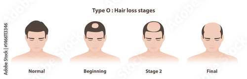 Type O hair loss stages in male pattern baldness illustration. Infographic stages of androgenetic alopecia, a round, oval bald patch on the crown or back of the head. Hair care and problem concept.