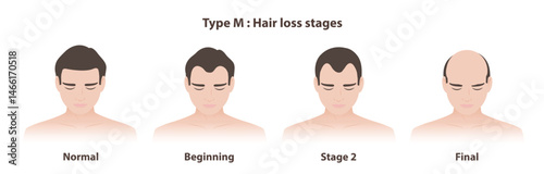 Type M hair loss stages in male pattern baldness illustration. Infographic stages of androgenetic alopecia, the hairline recedes at the temples, creating a M shape. Hair care and problem concept.
