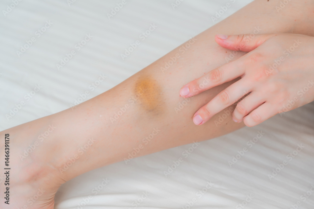 View on the woman leg with bruise, hematoma View on the woman leg with bruise, hematoma