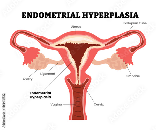 Endometrial Hyperplasia or intraepithelial neoplasia, female reproductive system, educational medical poster design healthcare scheme, labeled internal organs cervix, fertility problem infertility