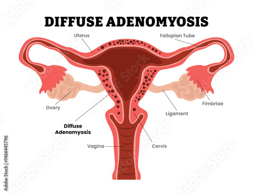 Adenomyosis, focal, adenomyoma, diffuse, female reproductive system, educational medical poster design healthcare scheme, internal organs cervix, fertility problem infertility. Internal endometriosis.