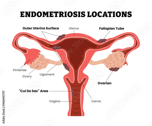 Endometriosis Locations, endometrium, outer, ovarian, female reproductive system, educational medical poster design healthcare scheme, labeled internal organs cervix, fertility problem infertility,