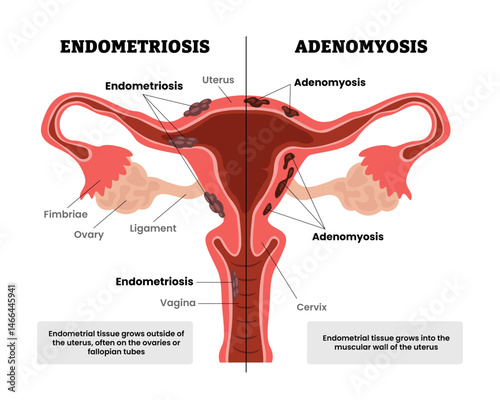 Difference between endometriosis vs adenomyosis, female reproductive system, educational medical poster design healthcare scheme, labeled internal organs cervix, fertility problem infertility,