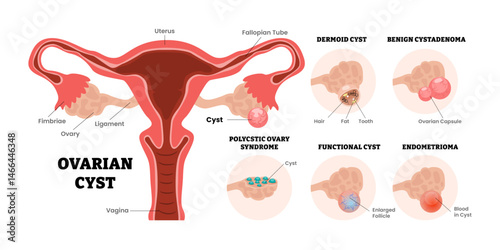 Different types of ovarian cyst types set collection, female reproductive system, educational medical poster design healthcare scheme, labeled internal organs cervix, fertility problem infertility.