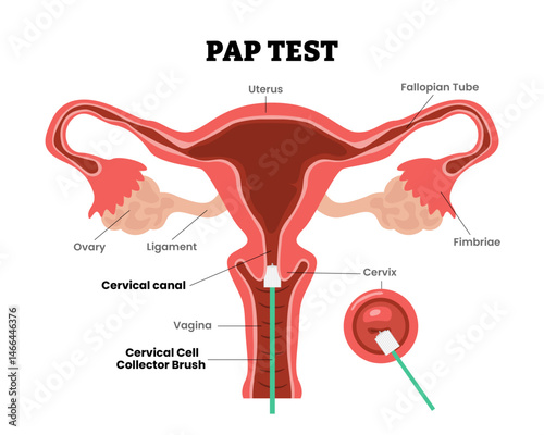 Pap Test, Pap smear or cervical cytology, female reproductive system, educational medical poster design healthcare scheme, internal organs cervix, fertility problem infertility, screening test.