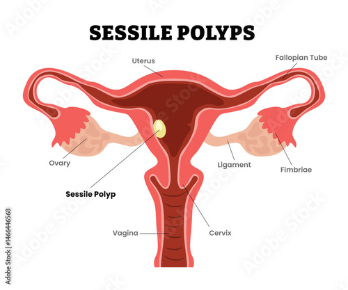 Uterine Polyps Endometrial Polyps, sessile polyps, female reproductive system, educational medical poster design healthcare scheme, internal organs cervix, fertility problem infertility