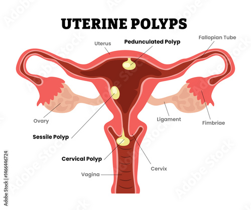 Uterine Polyps Endometrial Polyps, sessile, pedunculate, cervical,female reproductive system, educational medical poster design healthcare scheme, internal organs cervix, fertility problem infertility