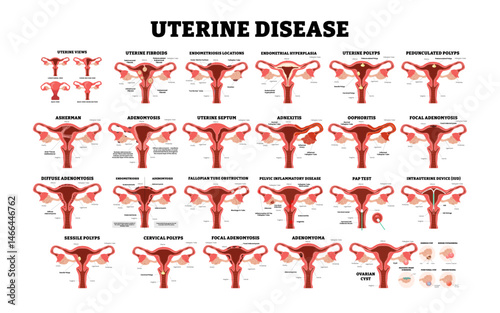 Different types of Uterine Disease set collection, female reproductive system, educational medical poster design healthcare scheme, labeled internal organs cervix, fertility problem infertility.