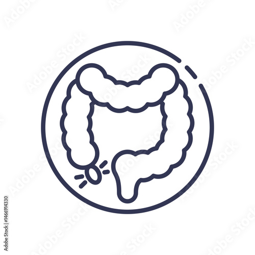Illustration of the human colon highlighting a polyp, indicating potential colorectal issues.
