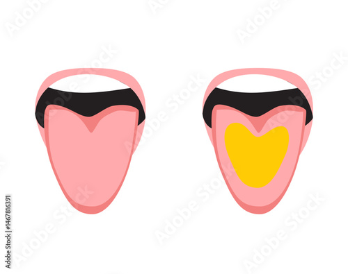 Cartoon infographic comparing a healthy pink tongue with a yellow coated tongue. Drawing for oral hygiene, symptoms, and health concept
