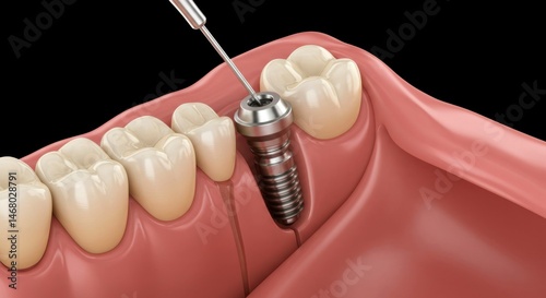 Dental implant procedure close-up