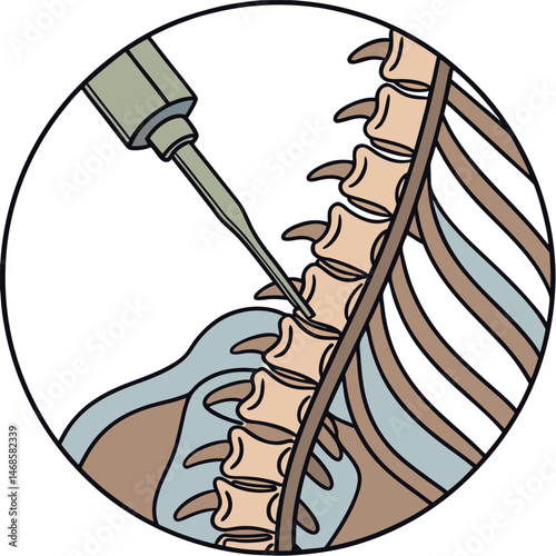 Illustration depicting a spinal injection procedure with needle and vertebrae bones